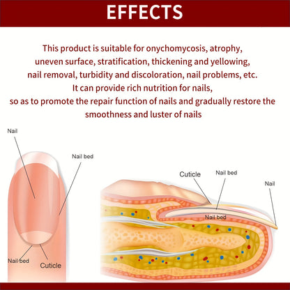 Líquido para tratamiento de hongos en las uñas de 0.68 oz - Fórmula 100% natural pura para uñas de los pies extrafuerte - Para uñas descoloridas, espesas, amarillas y con hongos - Solución antimicótica y hongos debajo de la uña - Uña con hongos